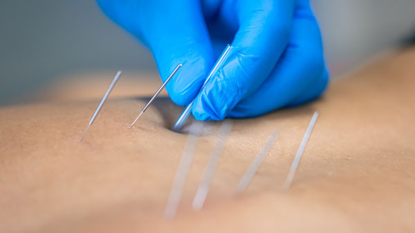 Dry Needling